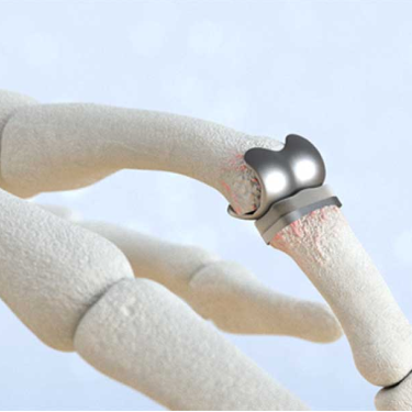 Finger Joint Replacement