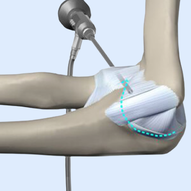 Elbow Arthroscopy