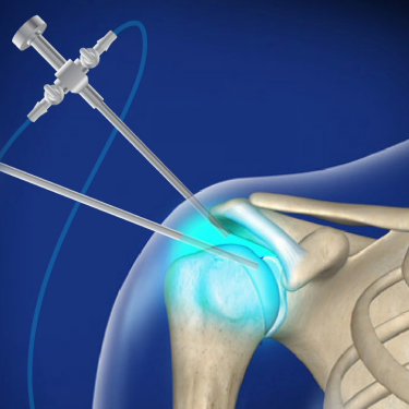 Shoulder Arthroscopy