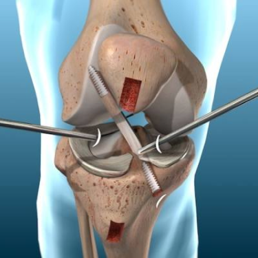 Knee Arthroscopy