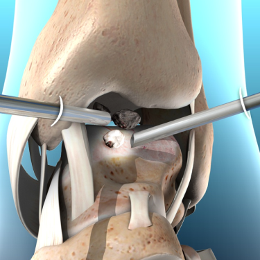Ankle Arthroscopy